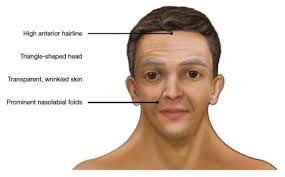 celebrities with noonan syndrome