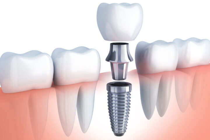 dental implants abroad helvetic clinics